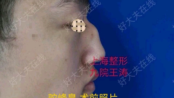 驼峰鼻综合整形哔哩哔哩bilibili