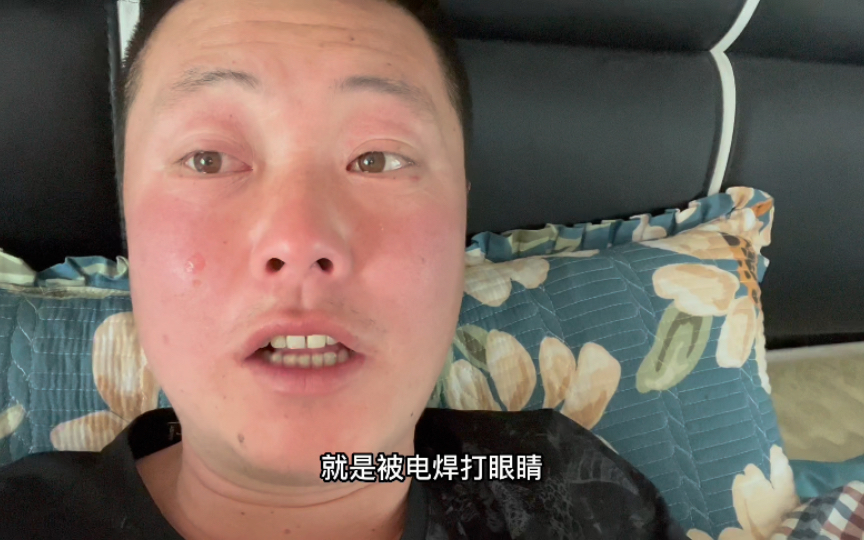 玩电焊眼睛受伤,脸烤破皮,太遭罪了