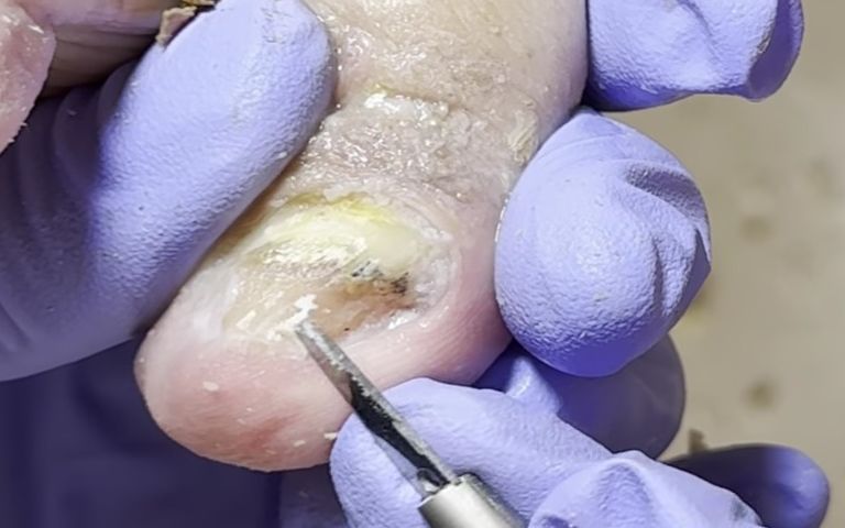 惊人的脚趾甲长度,完美的修脚~【刘一刀】