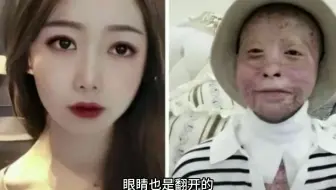 漂亮姑娘因汽车自燃被困车中，救出来已经完全毁容了，而她却说：活着就好！