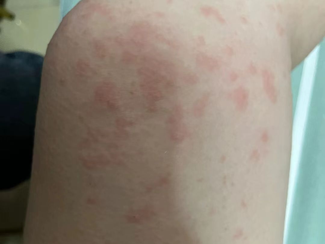 大腿内侧好多成片的红斑丘疹,别担心,教你科学消疹恢复好皮肤