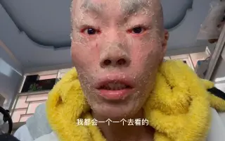 鱼鳞病 哔哩哔哩 Bilibili