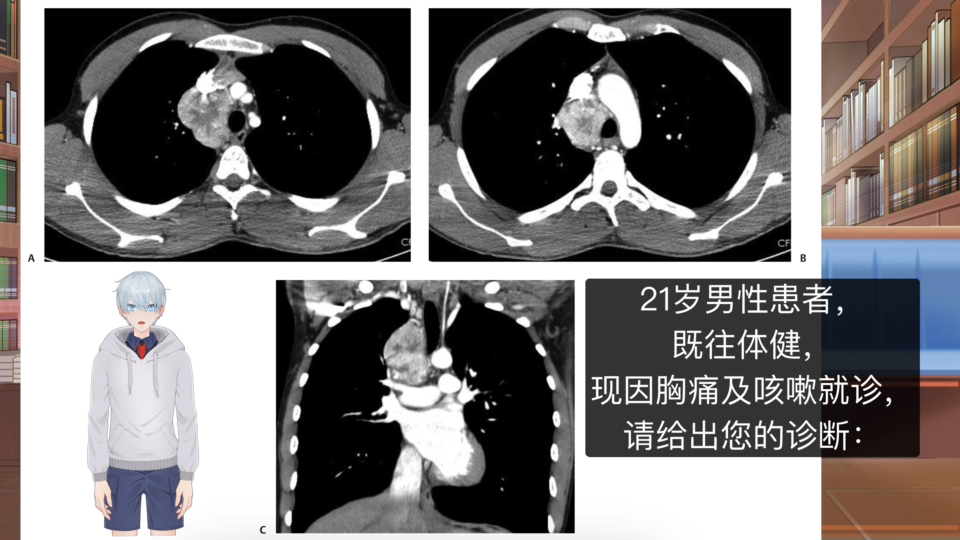 21岁男性患者,因胸痛及咳嗽就诊,发现纵隔巨大肿块,应如何诊断?哔哩哔哩bilibili