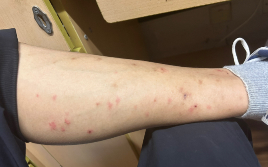 谁去杭州西湖能被蚊子叮成这样?谁懂呀?密集恐惧症了