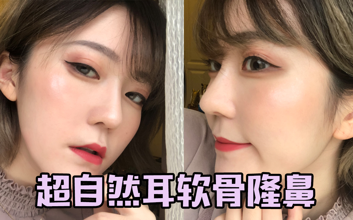 自然到亲妈都没发现的耳软骨隆鼻鼻综合术后恢复过程分享