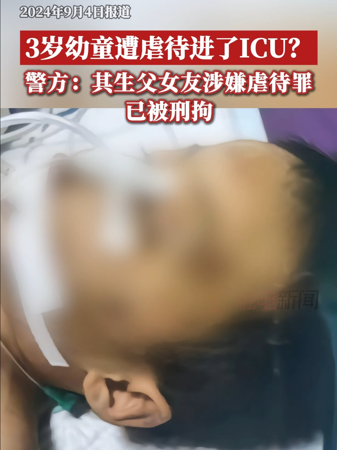 3岁幼童遭虐待进了ICU?警方:其生父女友涉嫌虐待罪哔哩哔哩bilibili