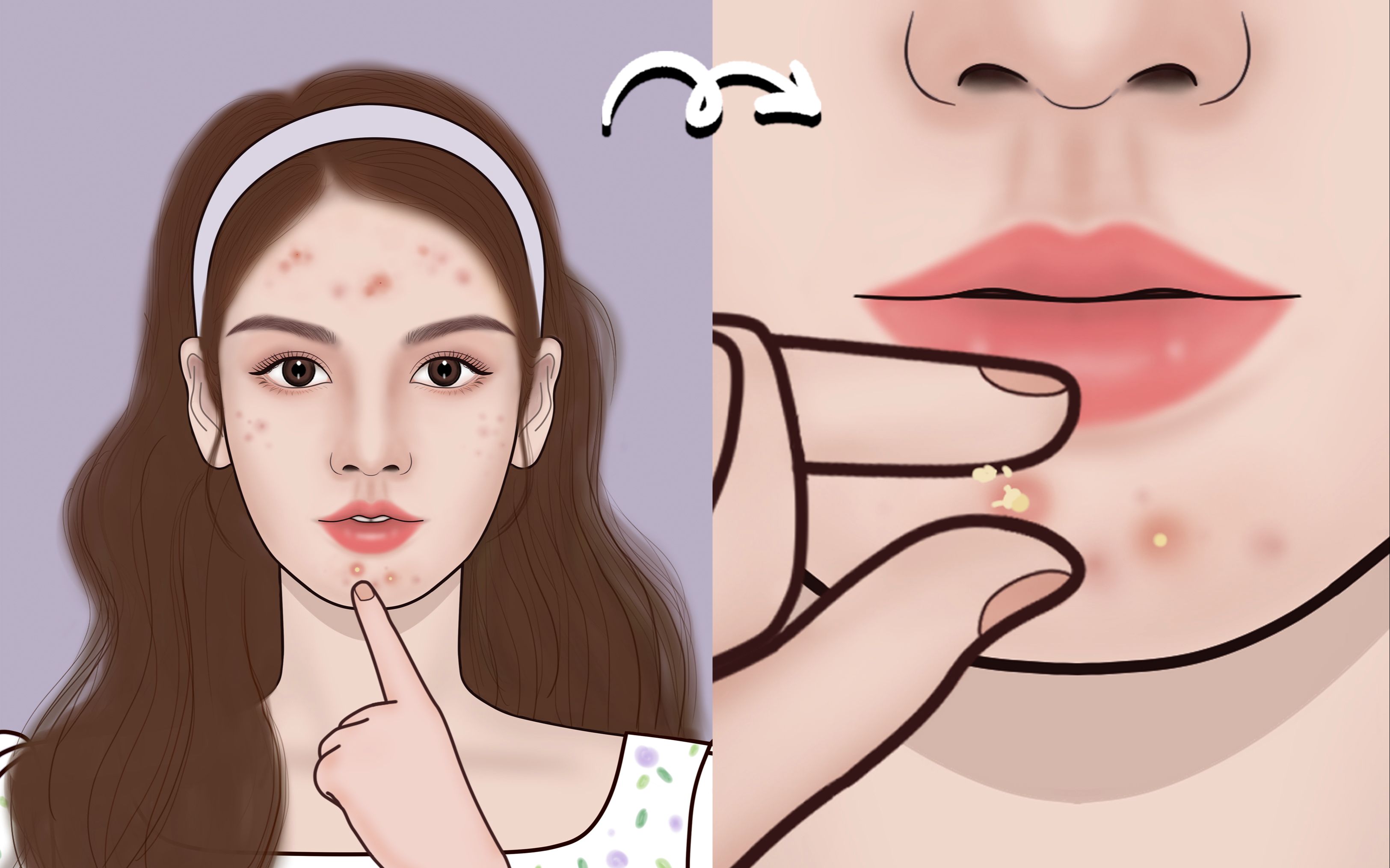 千万不要用手挤痘,顽固痘印真的让人心情乌云密布|萌大佬动画