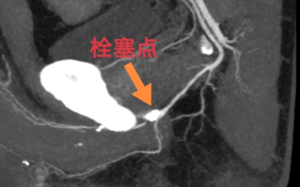 小伙得了人人羡慕的男科病,他自己却很痛苦哔哩哔哩bilibili