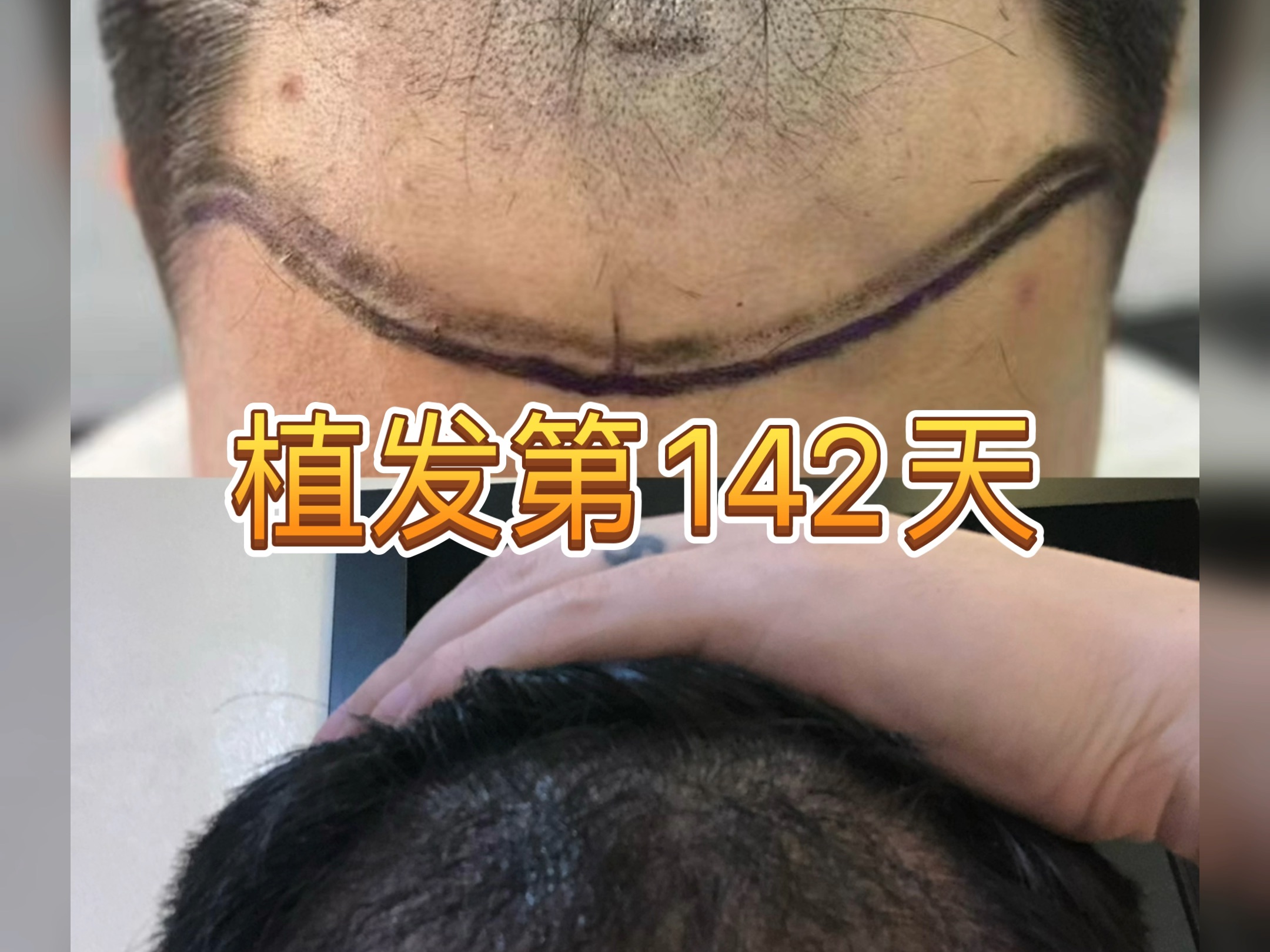 植发终生(植发是永久生发吗)