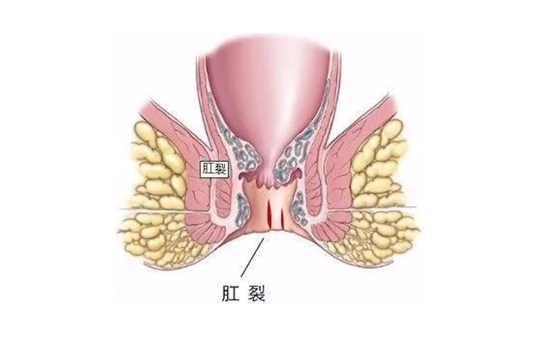 肛裂的位置的图片图片