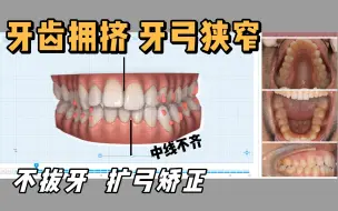 Скачать видео: 【矫正方案】牙齿拥挤 ，牙弓狭窄，不拔牙，扩弓获得牙齿间隙