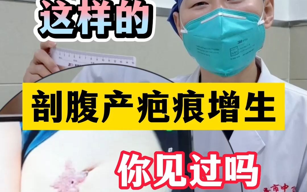 31岁妈妈剖腹产术后疤痕增生严重,这样的剖腹产疤痕你见过吗?哔哩哔哩bilibili