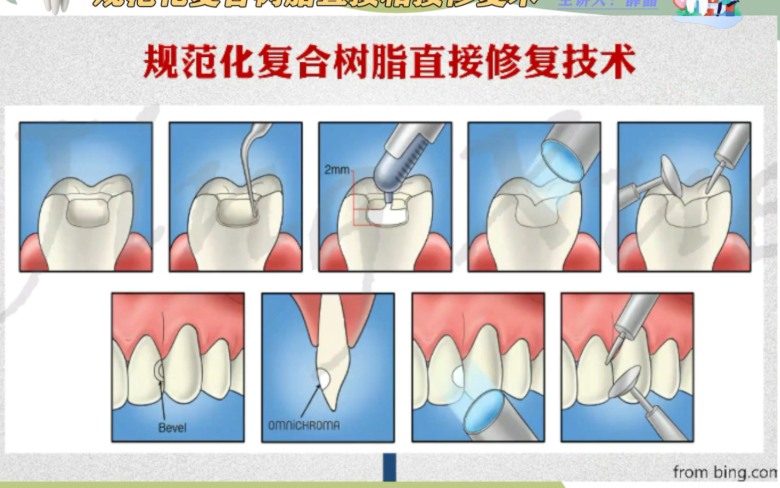 [图]规范化复合树脂直接粘接修复术——薛晶