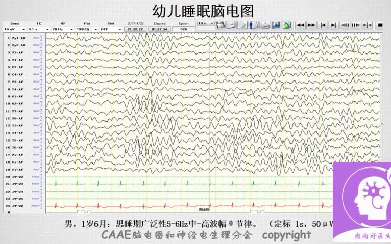 不同年龄段孩子正常脑电图之六:从儿童睡眠期脑电图来识别癫痫病哔哩哔哩bilibili