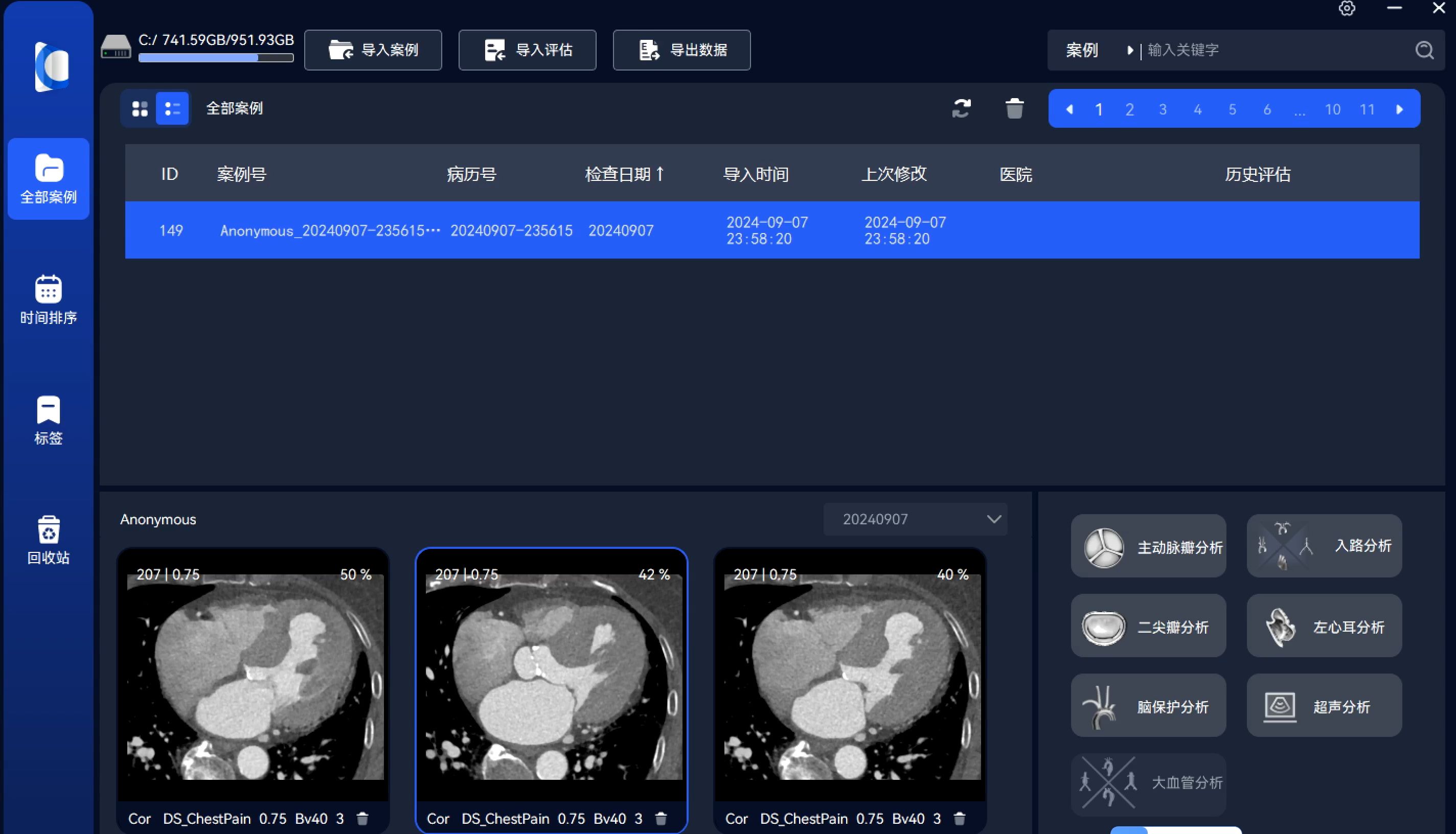 左室流出道心肌严重肥厚ASCardioverse哔哩哔哩bilibili