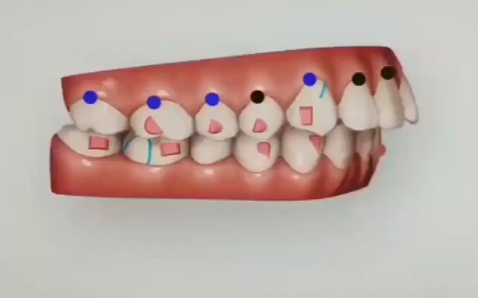 矫正医生为啥建议你磨牙后移?哔哩哔哩bilibili
