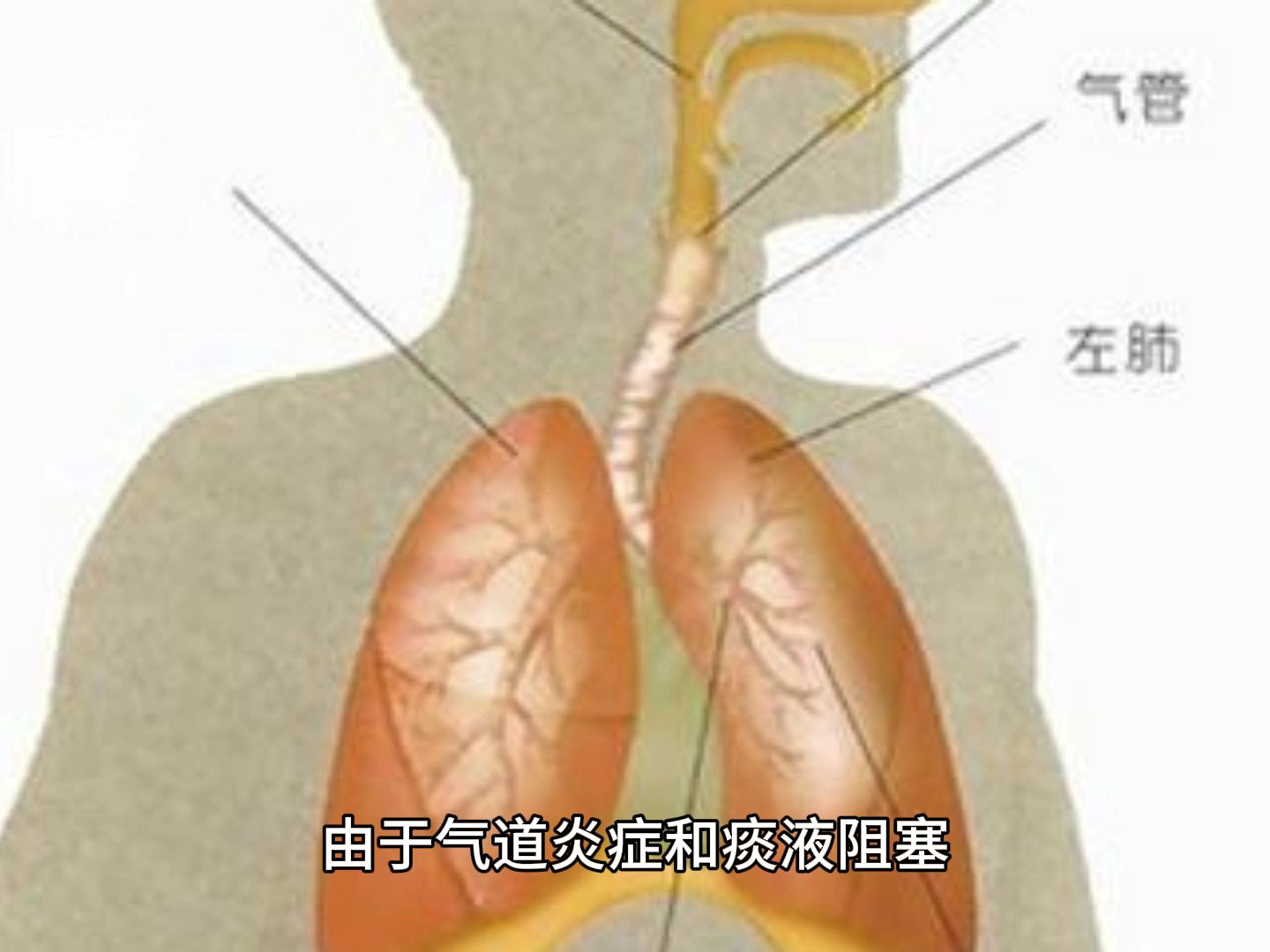 支气管扩张有哪些症状郭健