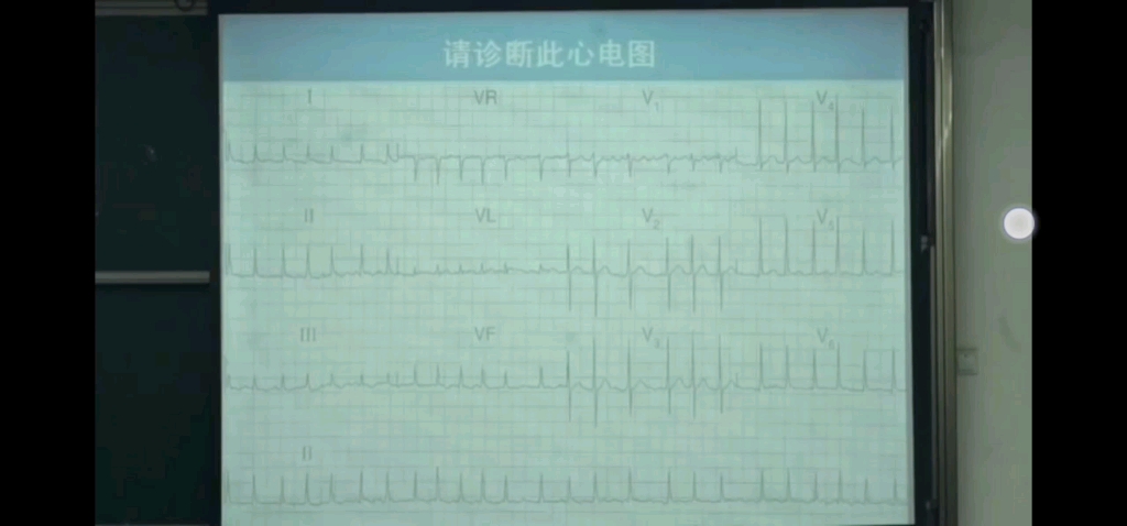 心电图 窦性P波的诊断要点哔哩哔哩bilibili