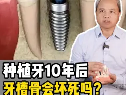 Tải video: 种植牙10年后，牙槽骨会坏死吗？