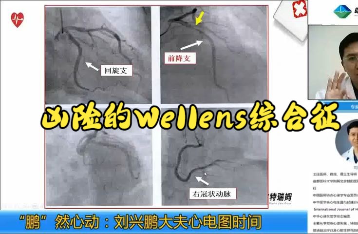 刘兴鹏心电图 凶险的Wellens综合征哔哩哔哩bilibili