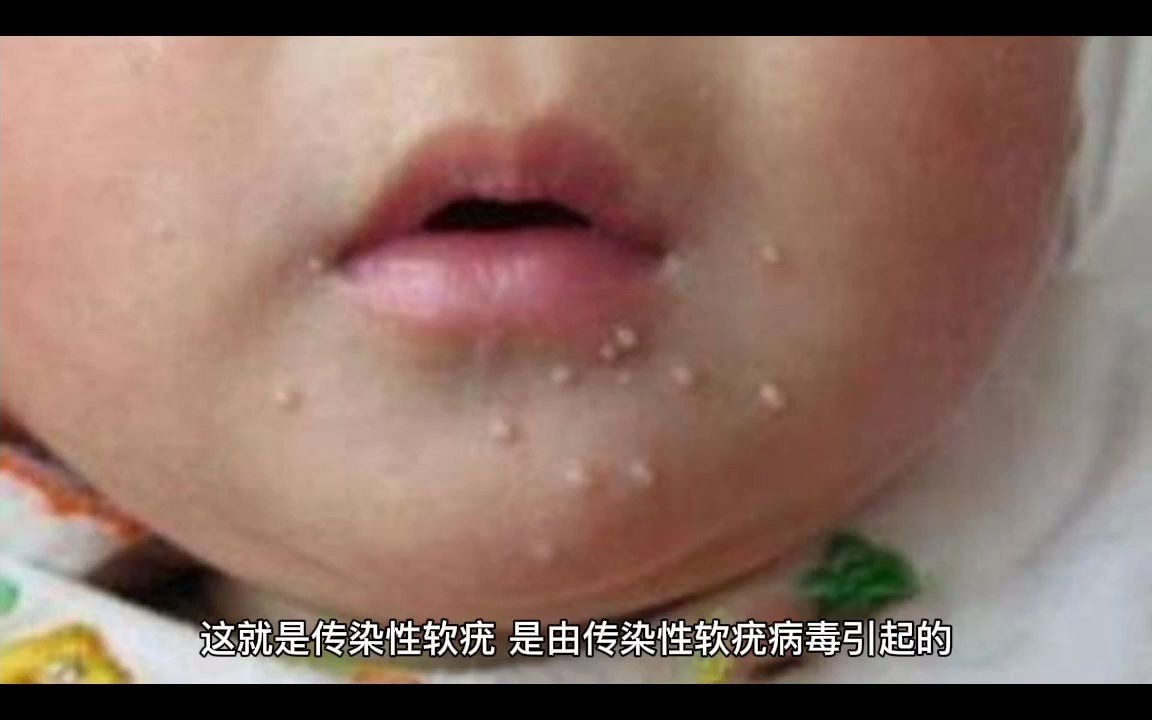 长这种丘疹,试试这样做?哔哩哔哩bilibili