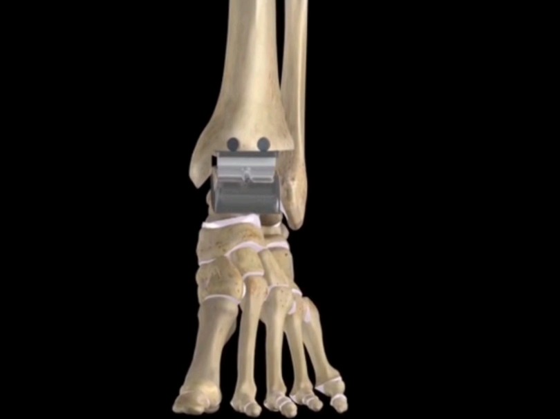 身体维修|踝关节置换术