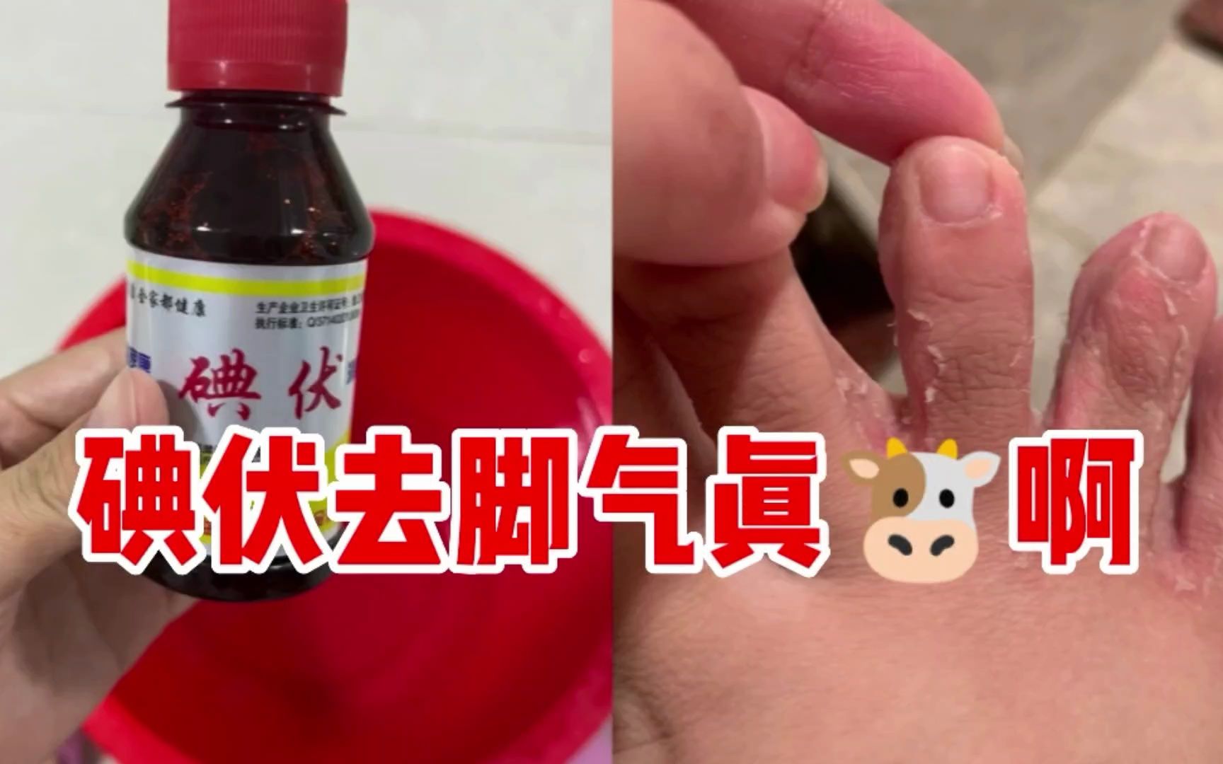 腳臭腳味大,碘伏去腳氣真牛,全部通通搞定