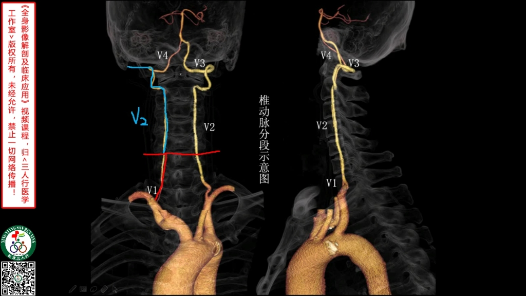 椎动脉分段4分法图片