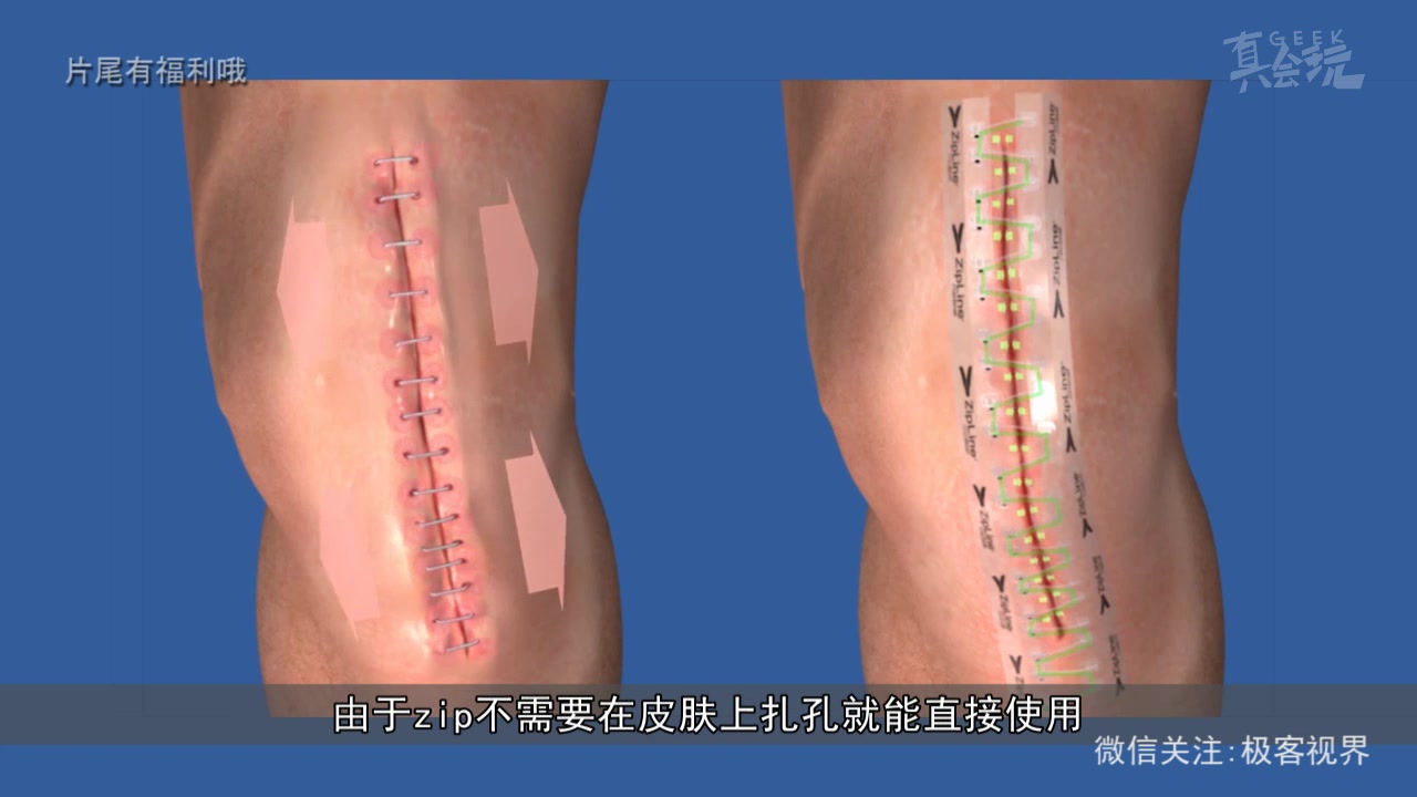 缝合伤口竟然像贴创可贴一样简单,还不会留下疤痕,这个像胶带一样的东西竟然如此神奇哔哩哔哩bilibili