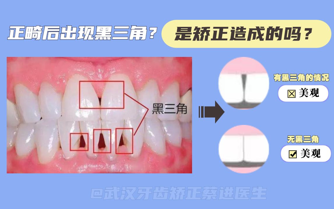 武汉牙齿矫正蔡进正畸课堂:正畸之后出现黑三角?是矫正造成的吗?哔哩哔哩bilibili