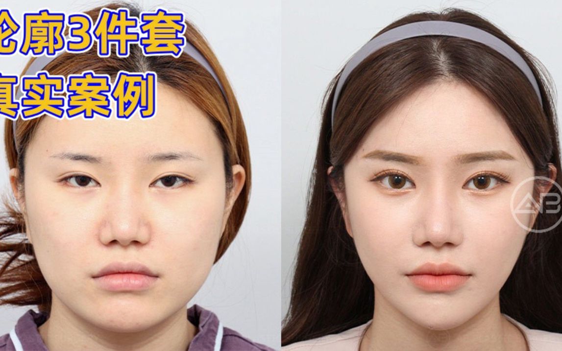 韩国ab整形外科 - 轮廓3件套 真实案例分享