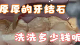 为什么洗牙价格从300到3000差距那么大？牙龈底下的洗牙痛吗？