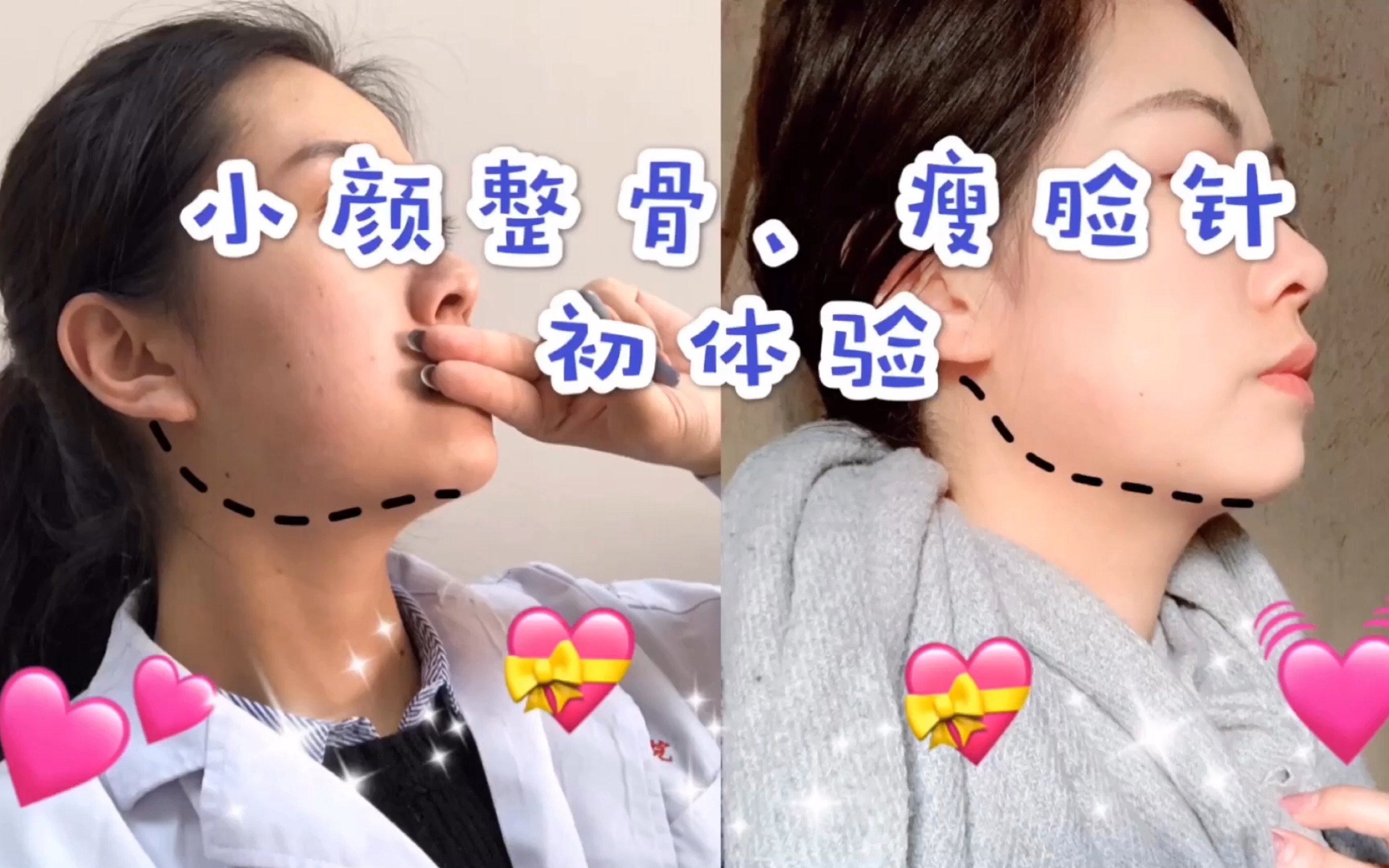 分享!日式小颜整骨&肉毒杆菌瘦脸针 之 /初体验/_哔哩哔哩_bilibili