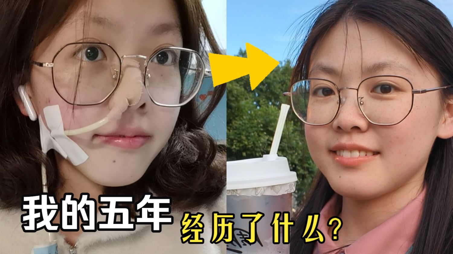 确诊克罗恩病五年以来，我的生活怎么样了？