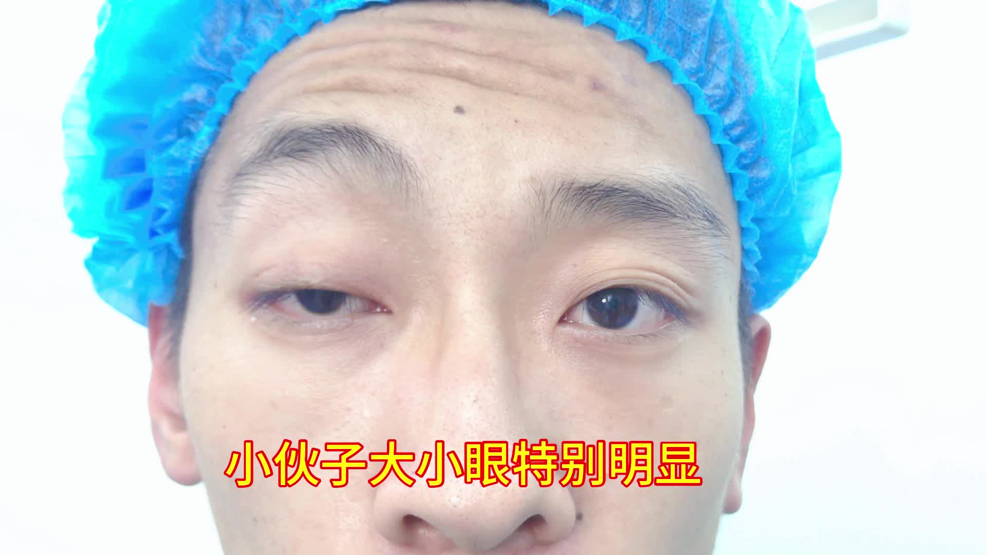 男生眼睛小、无神、抬头纹明显,很有可能存在上睑下垂,可以通过矫正改善.哔哩哔哩bilibili