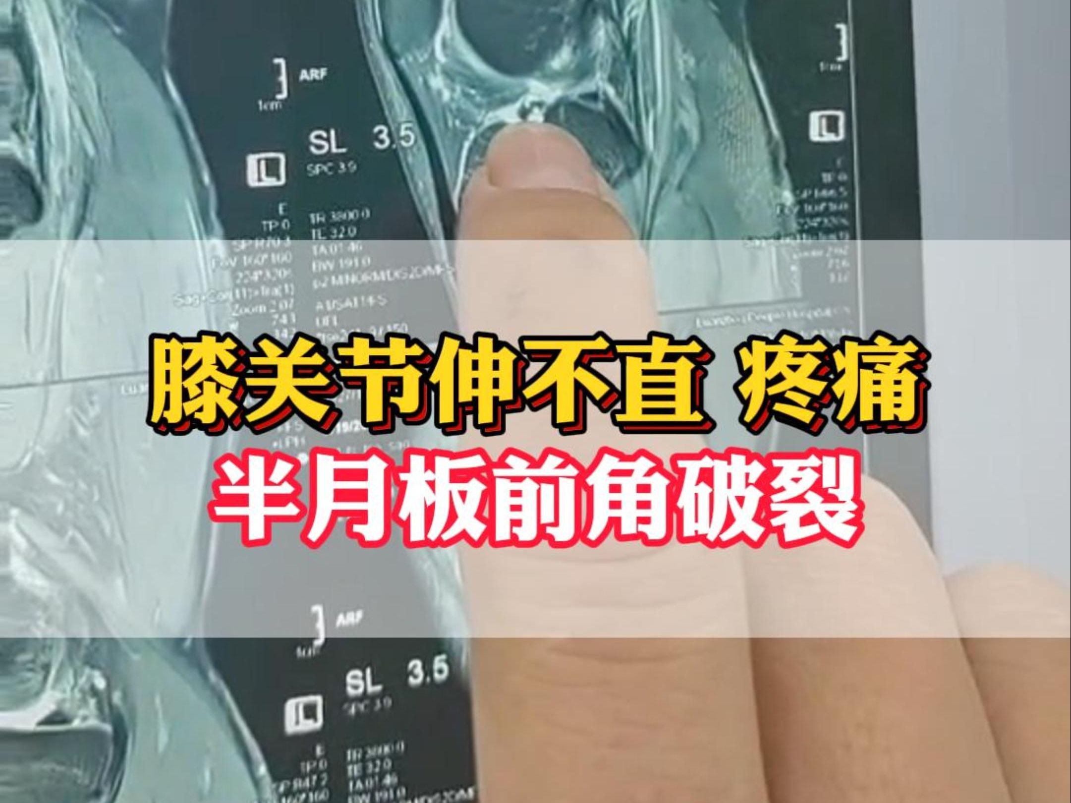 半月板前角破裂,膝盖疼痛保守四个月还是很痛,只能手术
