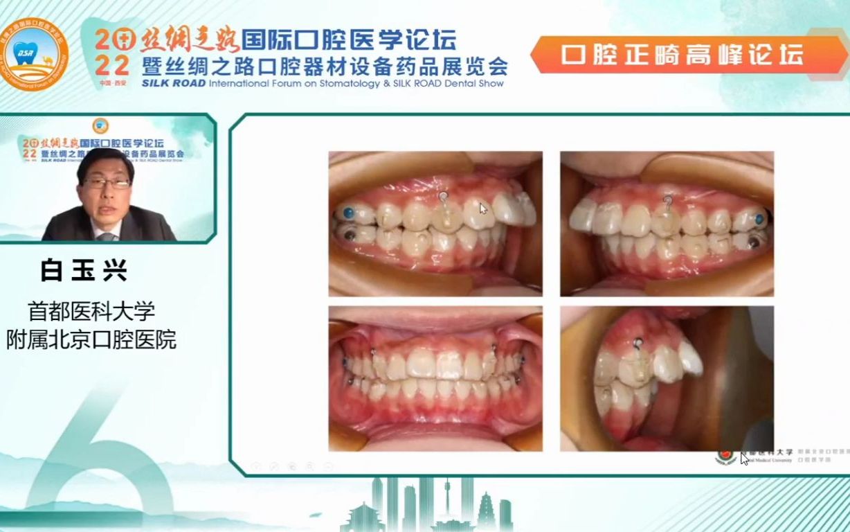 [图]2022 丝绸之路口腔医学正畸论坛 上午专家场（白玉兴教授）