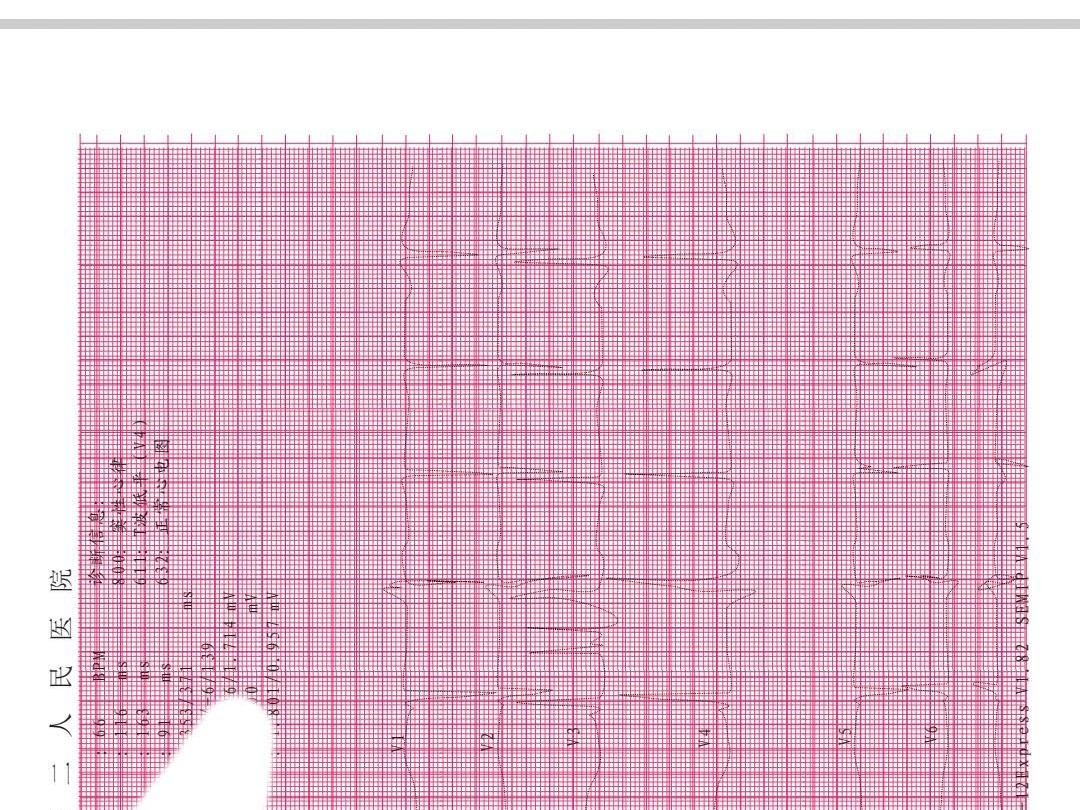 因为心电图被拒入职图片