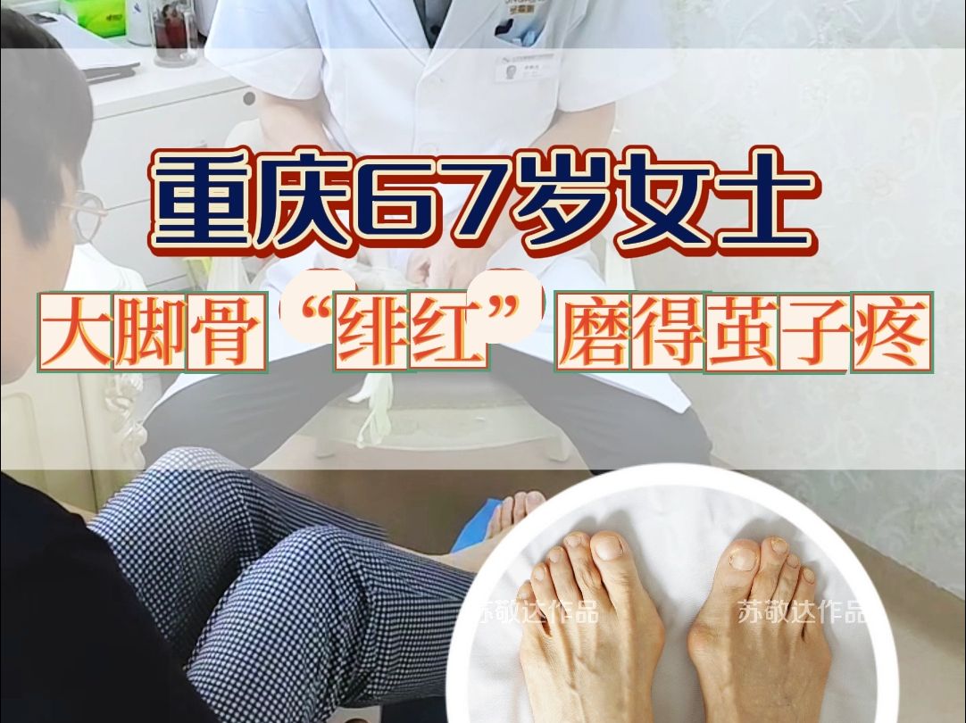 【苏敬达】67岁阿姨大脚骨走路久了就疼痛难忍,特意从重庆来北京做