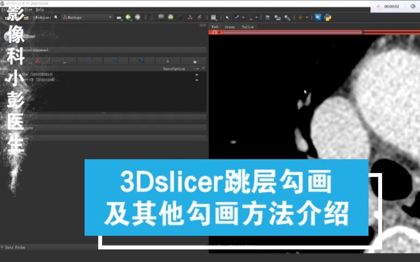 [图]【影像组学】0.625mm层厚的图像，3Dslicer如何更快勾画？