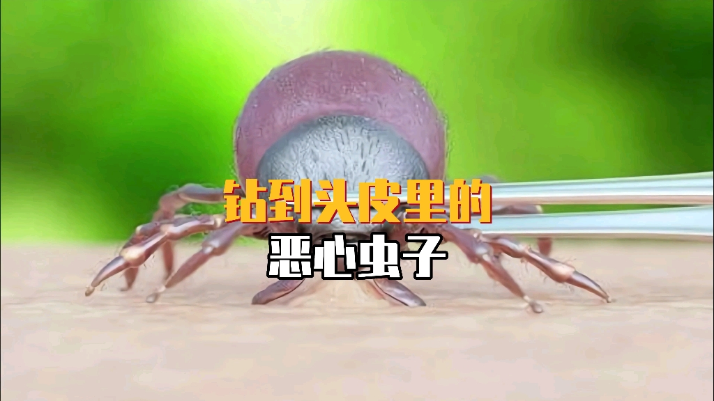 钻到头皮里的恶心虫子