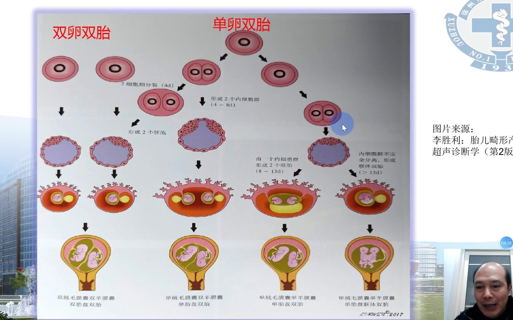 [图]双胎妊娠超声检查