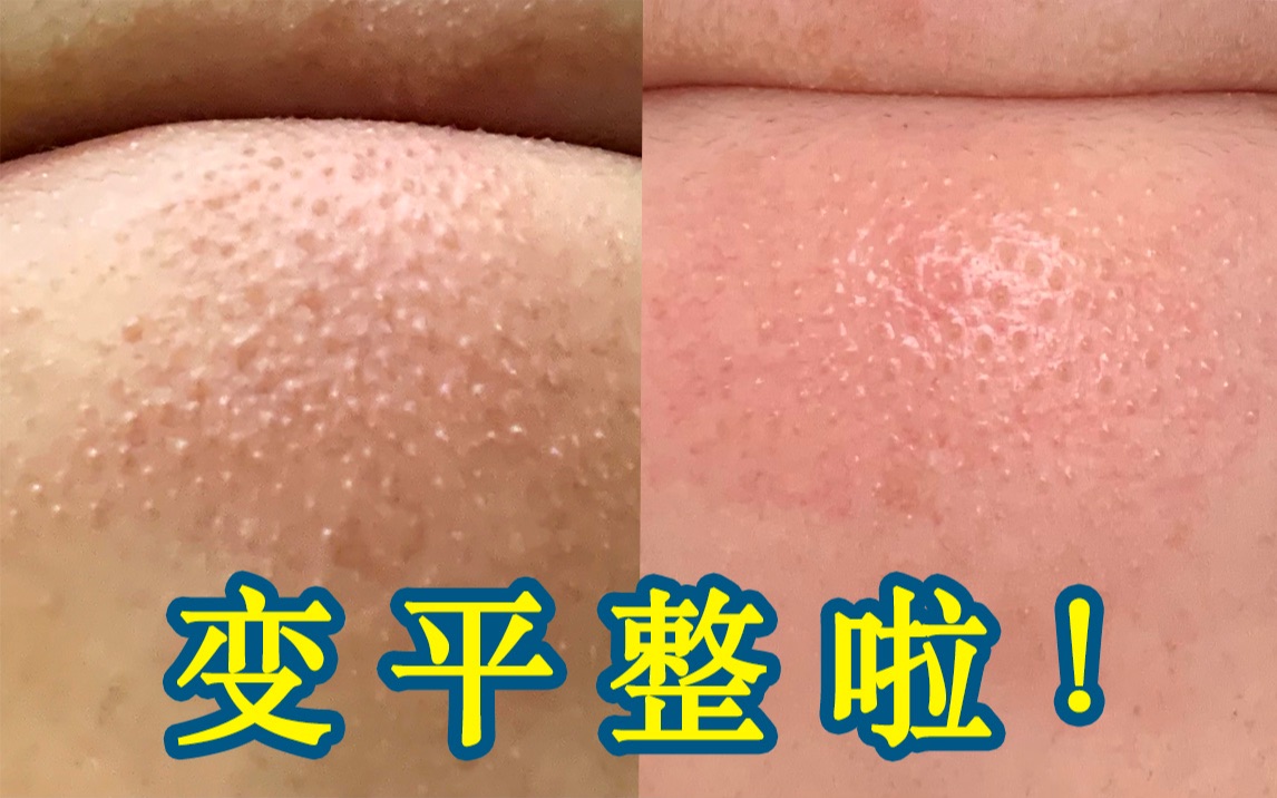 下巴终于变平整了些!闭口,粉刺,毛周角化怎么办?