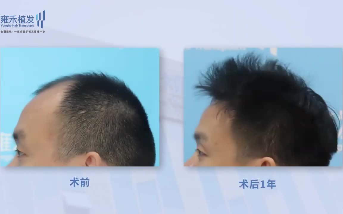 [图]澳門頭頂加密植髮效果可靠嗎？大陸髪友分享植髮心得！Yonghe hair transplant