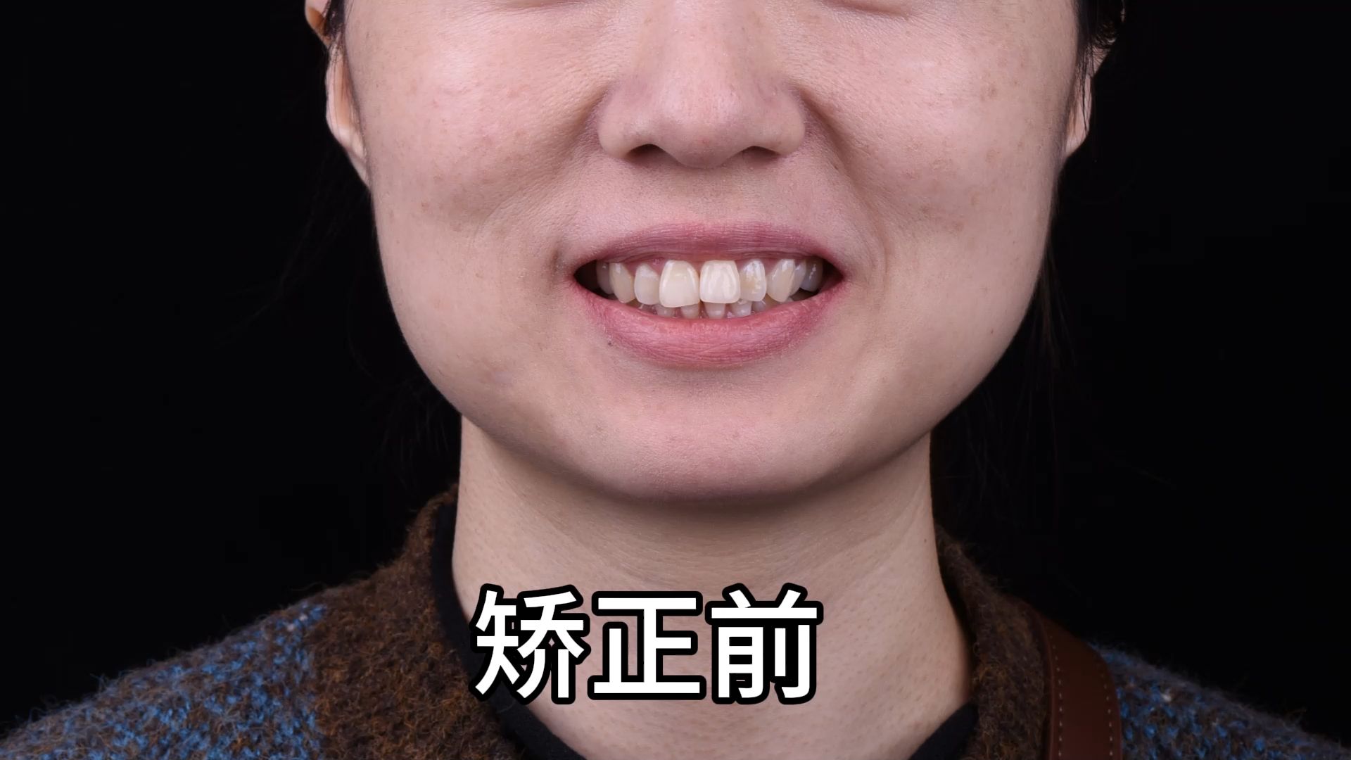 中度深覆合,两年正畸结束过程|深圳整牙
