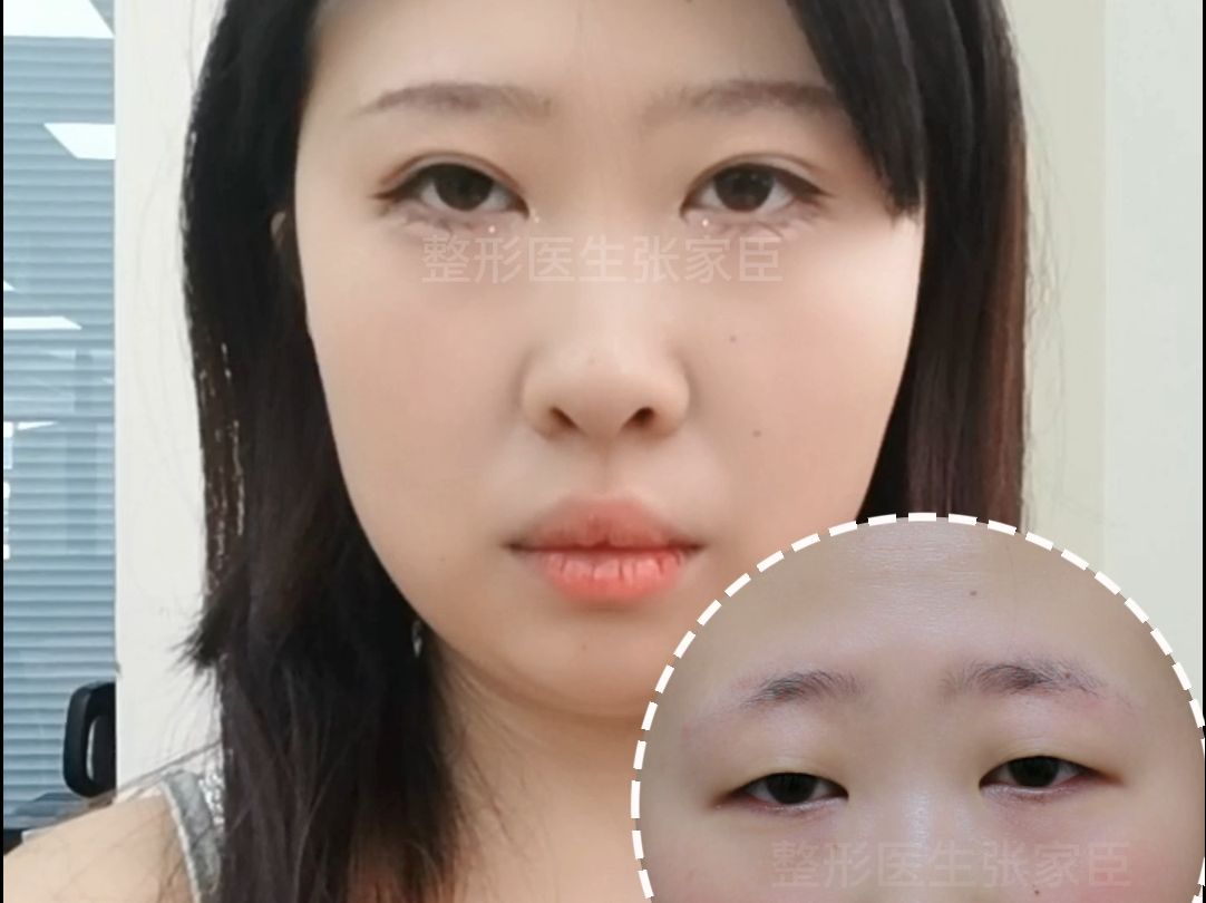 切开重睑 提肌矫正术后60天视频反馈