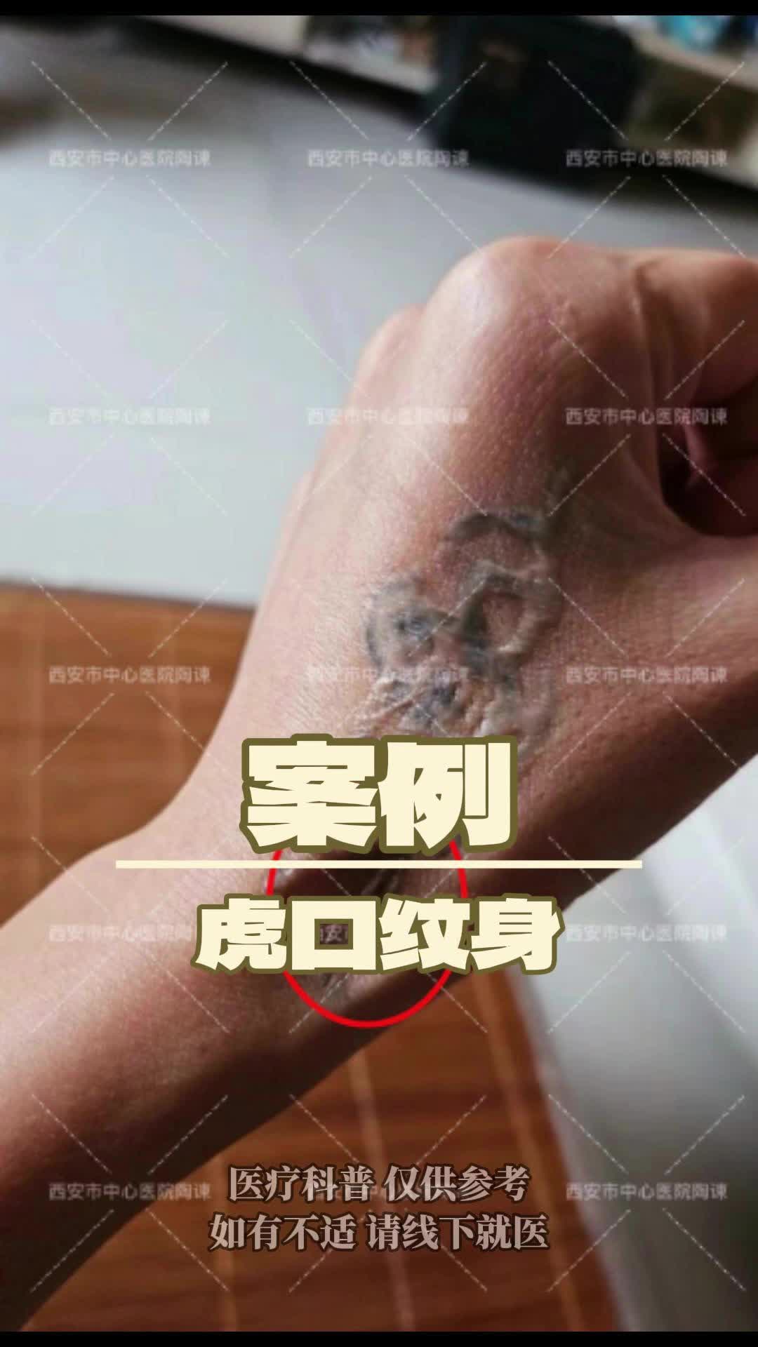 虎口纹身切除案例