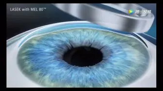 下载视频: Epi-lasik、LASEK、PRK3种激光近视矫正手术3D演示