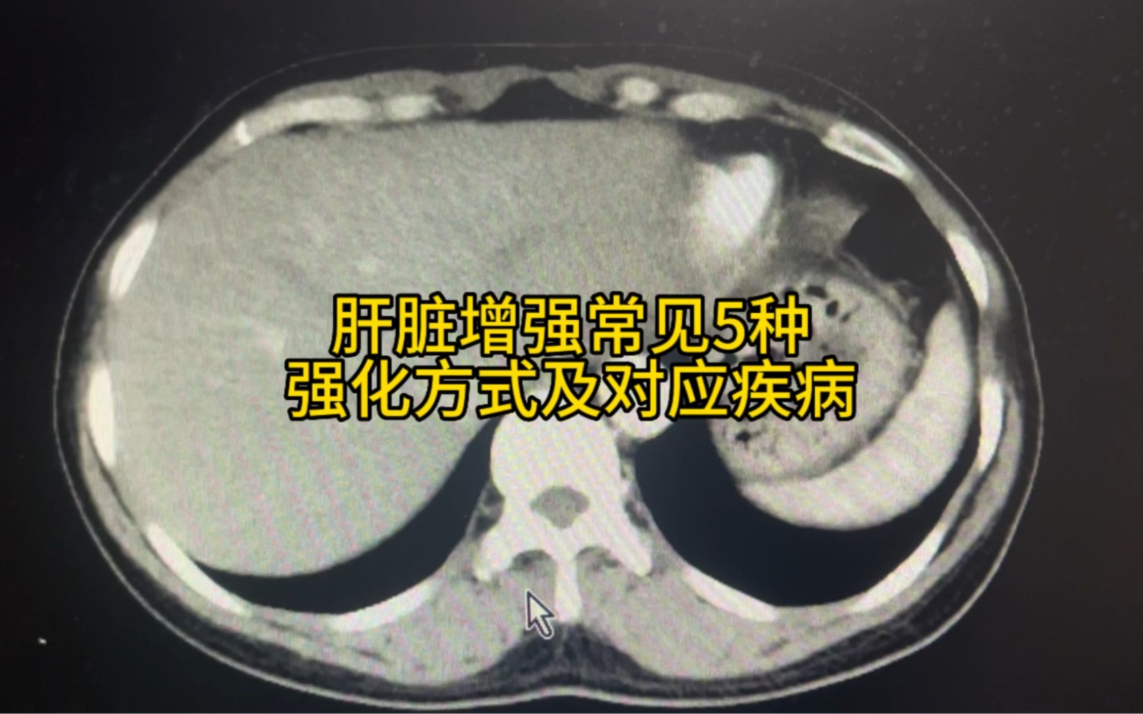 肝脏增强常见5种强化方式及相应疾病影像学表现