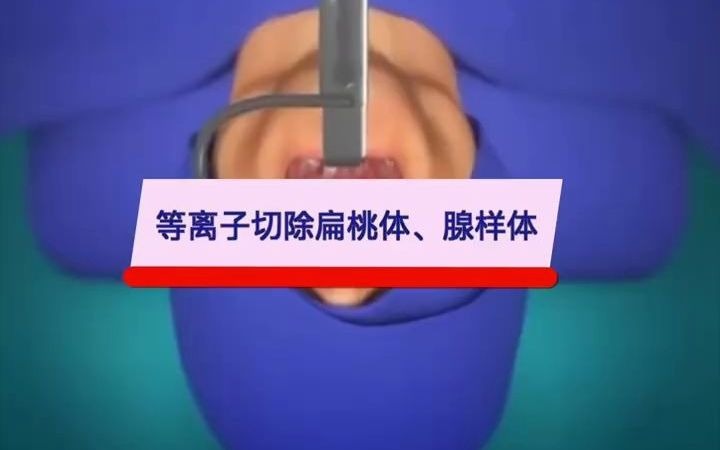 低温等离子切除扁桃体腺样体